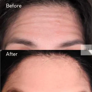 Botox treatment before and after the image | Beverly Hills, CA | Ara Med Spa