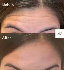 Botox treatment before and after the image | Beverly Hills, CA | Ara Med Spa