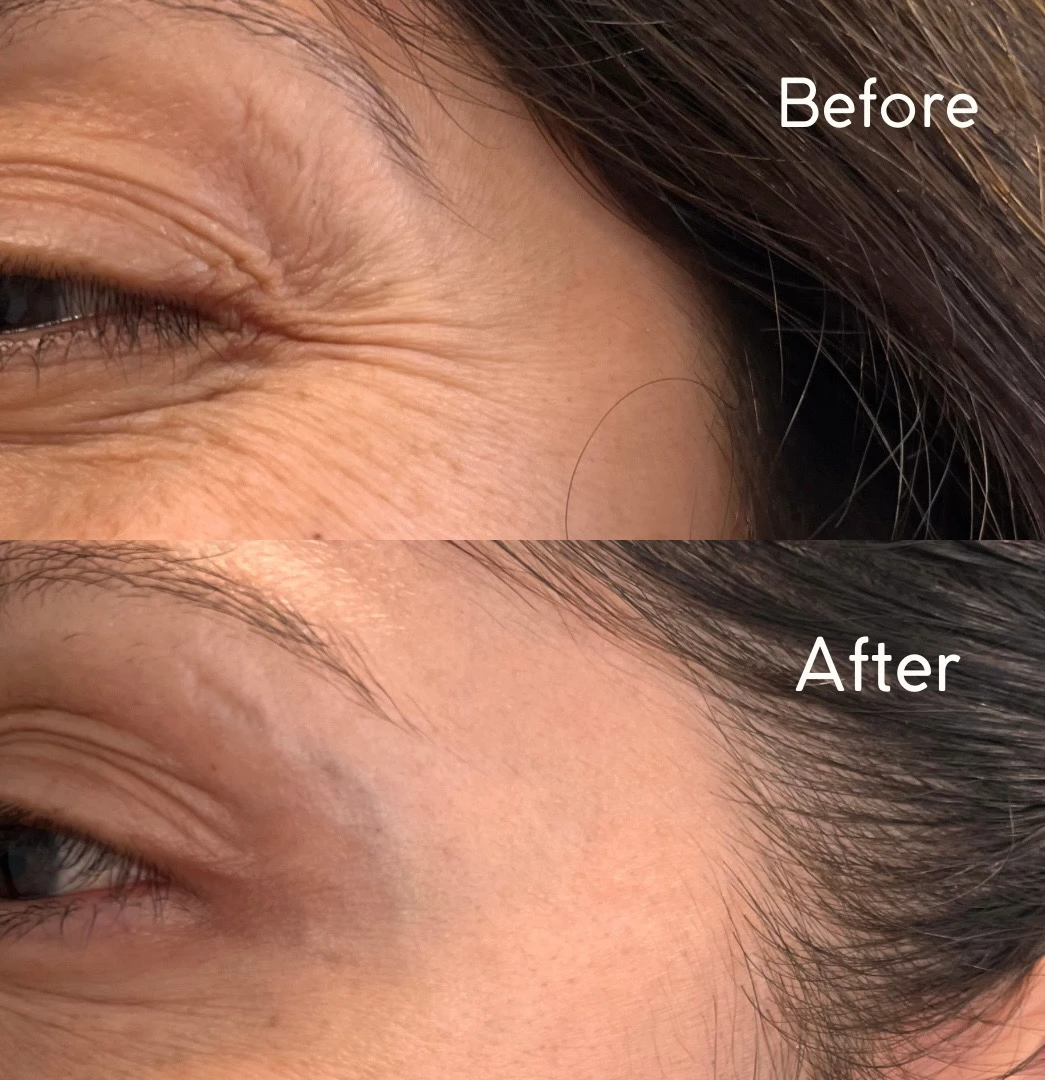 Before and After| ARA Med Spa Inc | Beverly Hills CA