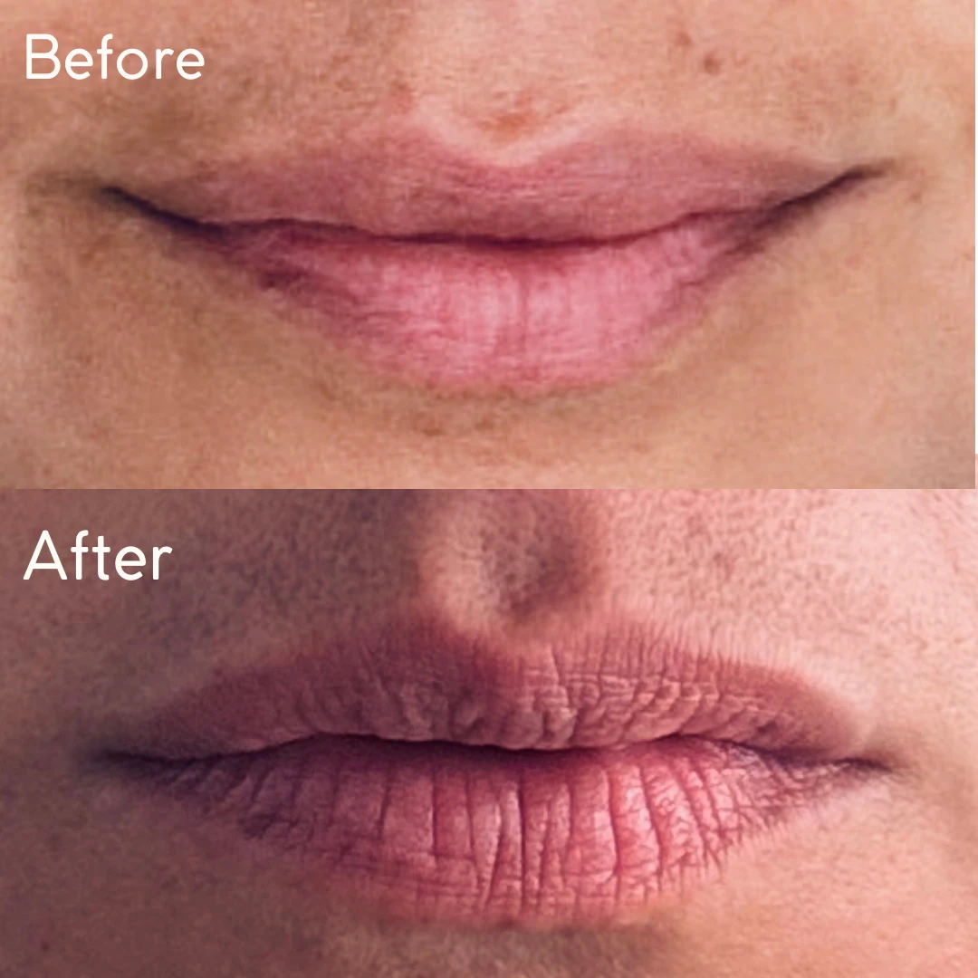 Before and After| ARA Med Spa Inc | Beverly Hills CA