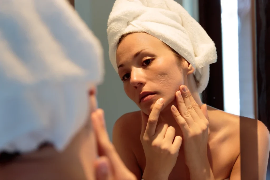 Woman examining acne scars before SkinPen microneedling treatment for smoother skin